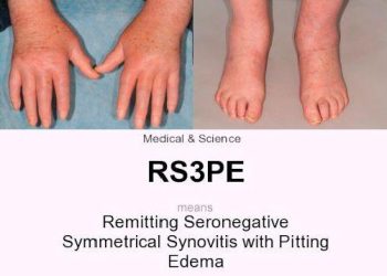 rs3pe treatment in gbh hospital udaipur