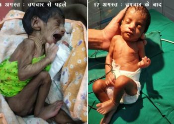 severe malnutrition newborn baby ananta hospital successfully treats her
