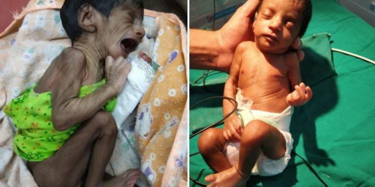 severe malnutrition newborn baby ananta hospital successfully treats her