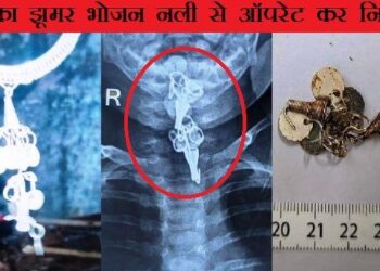 geetanjali hospital doctors team remove bracelet chandelier stuck in food pipe of 6 month old baby -1
