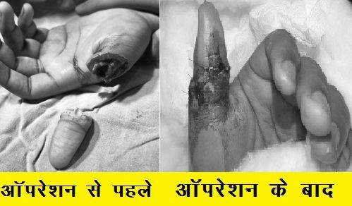 udaipur Geetanjali Hospital Dr. Yogesh Sharma Reimplant thumb severed from hand