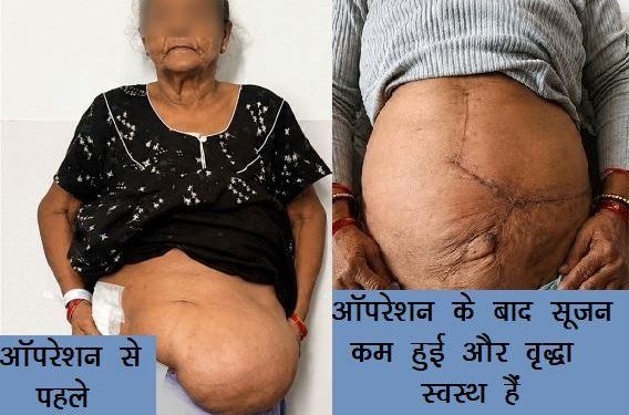 geetanjali-hospital-udaipur-77-year-old-giant-hernia-surgery-success